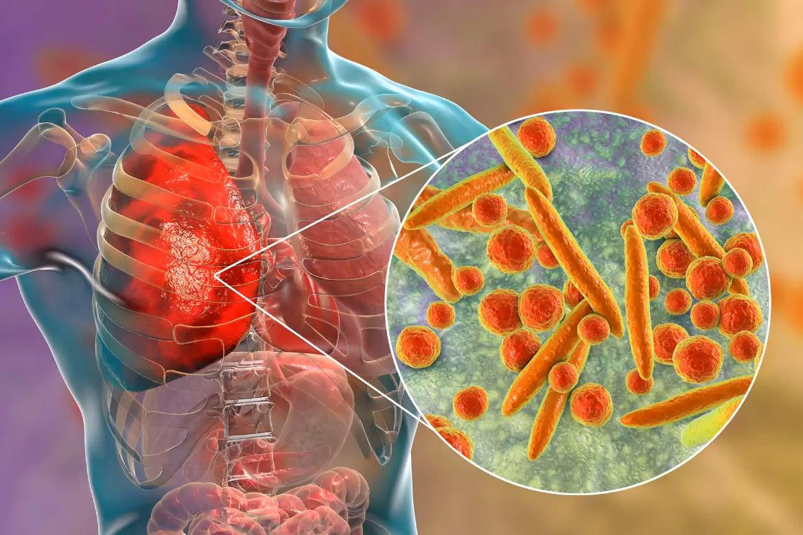 ¿Cuál es el tratamiento de la tuberculosis?