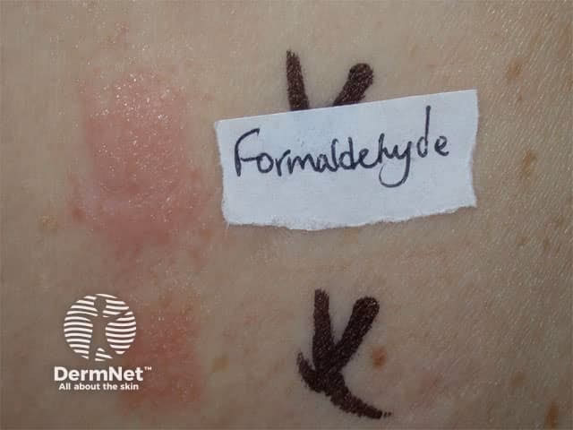 Do you have a contact allergy to formaldehyde?