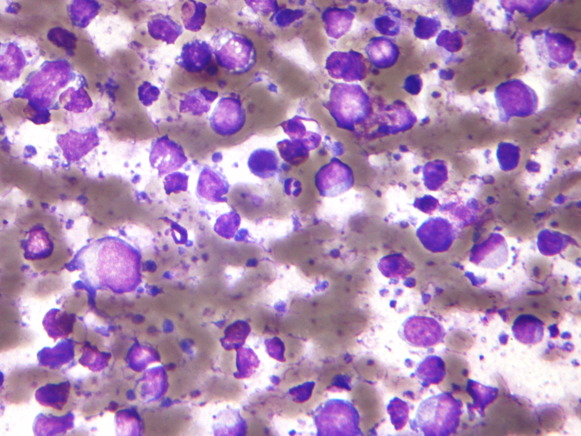 What are the different types of B-cell lymphoma?