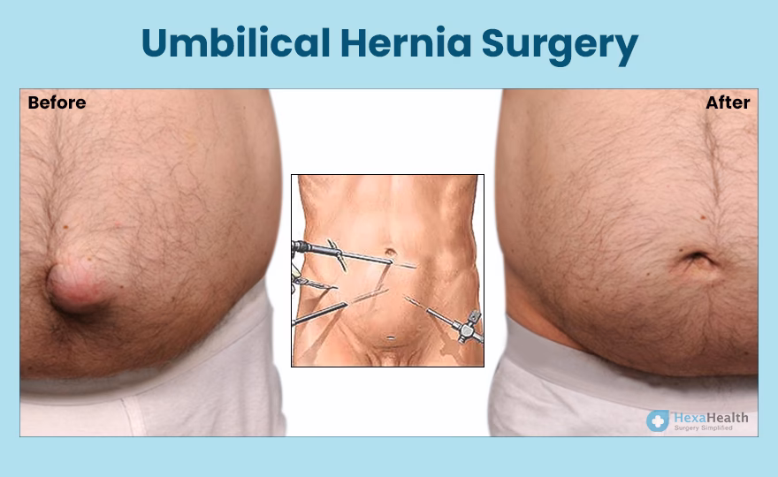 What happens after umbilical hernia surgery?