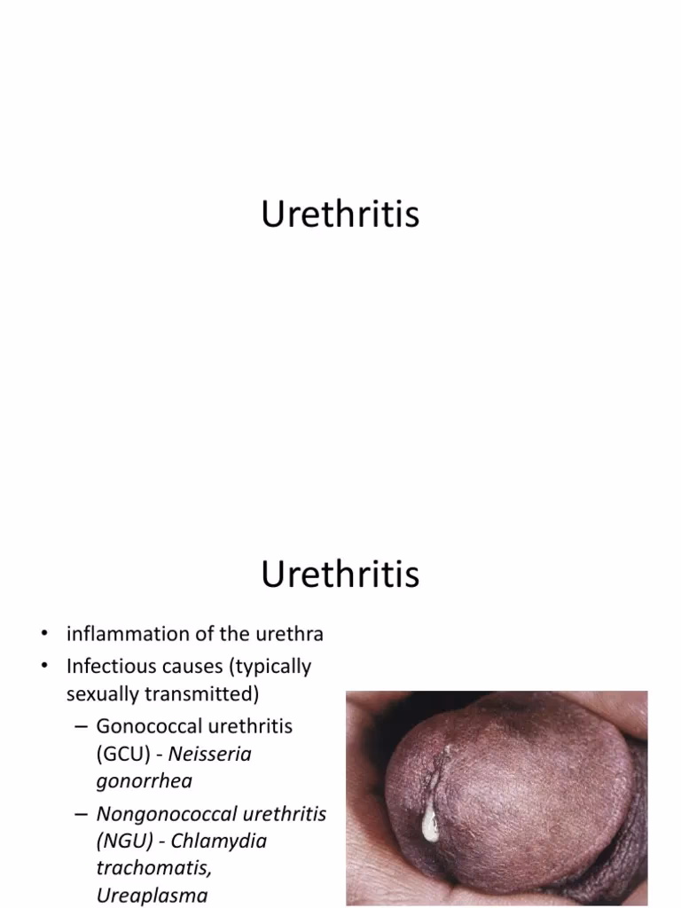 What if urethritis is not caused by an infection?