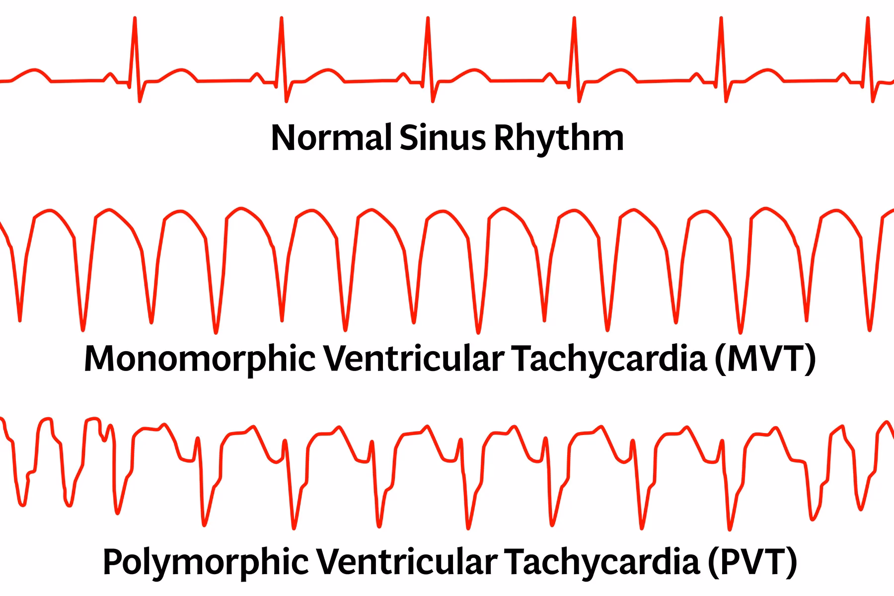 What is a normal ventricular tachycardia rate?