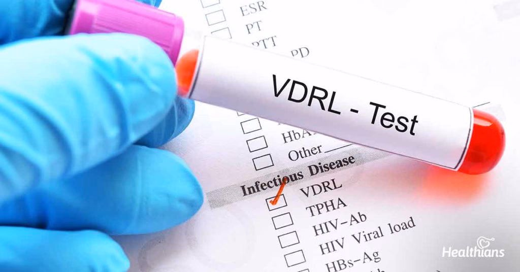 Is VDRL a screening test for syphilis in HIV reactive patients?