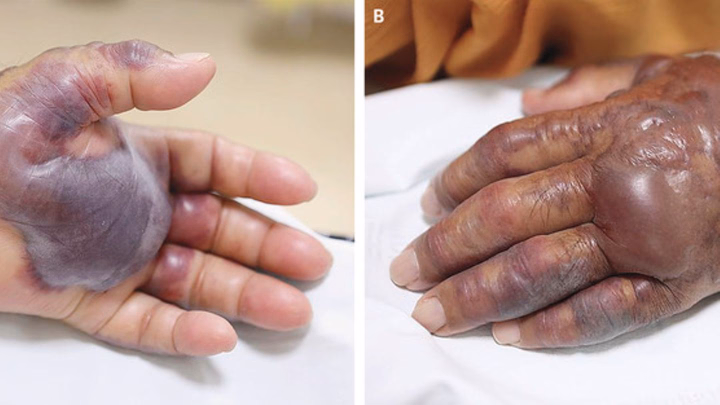 Wie behandelt man eine Infektion?