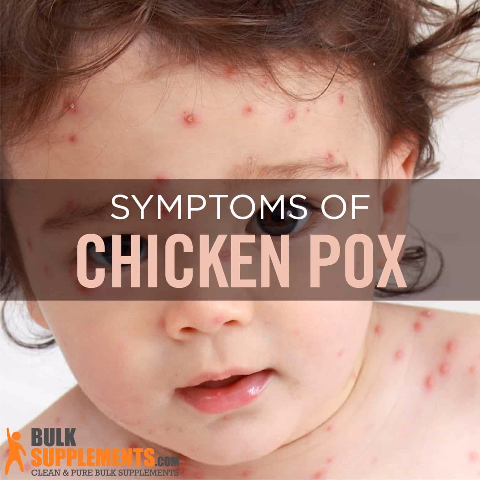 Can I get immunoglobulin for chickenpox?