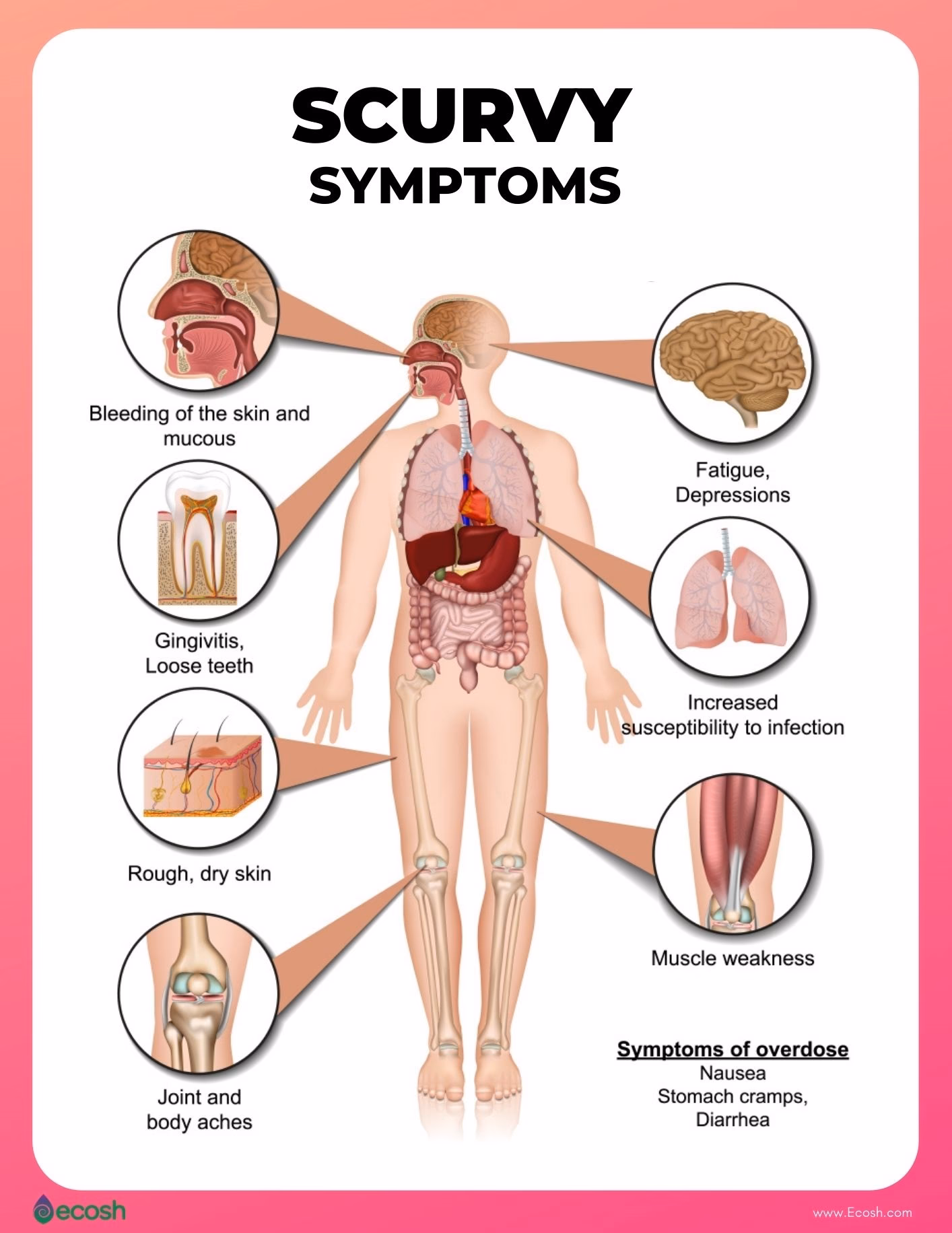 What happens if you eat too much vitamin C?