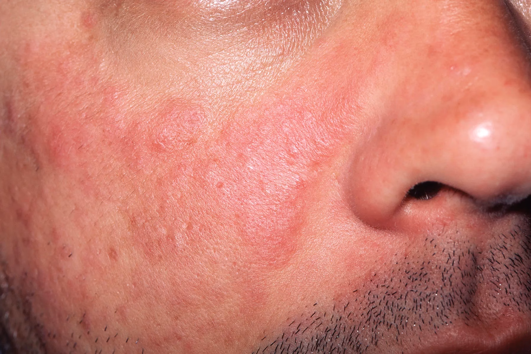 How does lupus nephritis affect vitamin D levels?