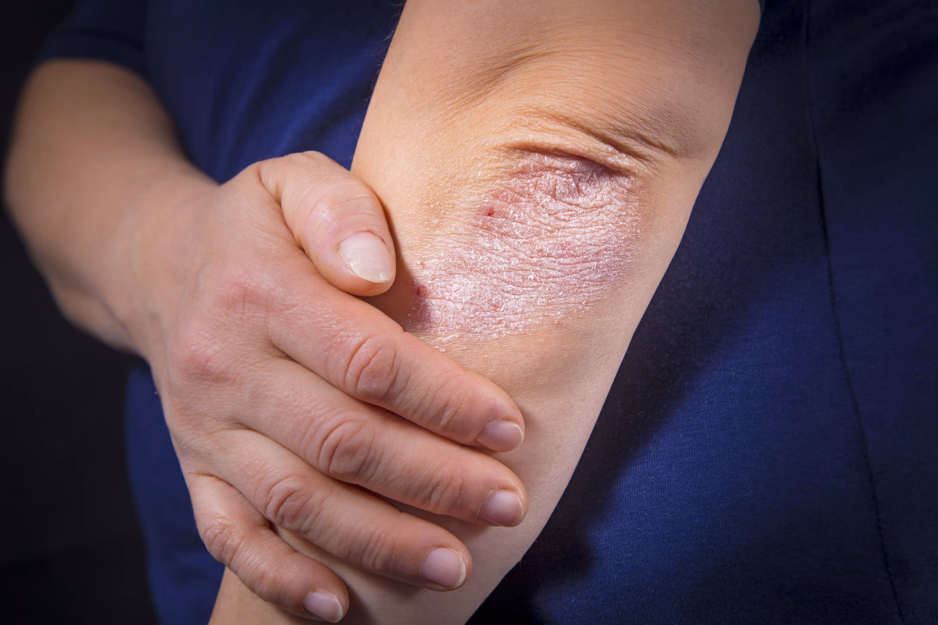 Can thiazide diuretics help psoriatic arthritis?