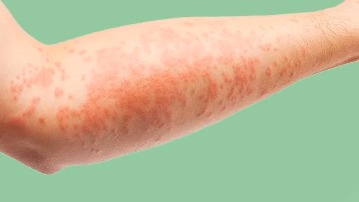 How does vitamin D affect eczema & allergies?