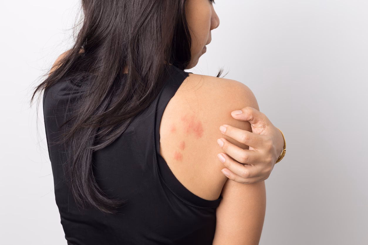 How does vitamin D affect eczema & allergies?