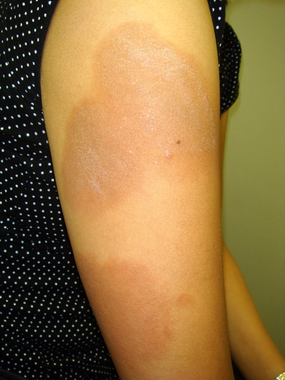 Can a vitamin K1 injection cause anaphylaxis?