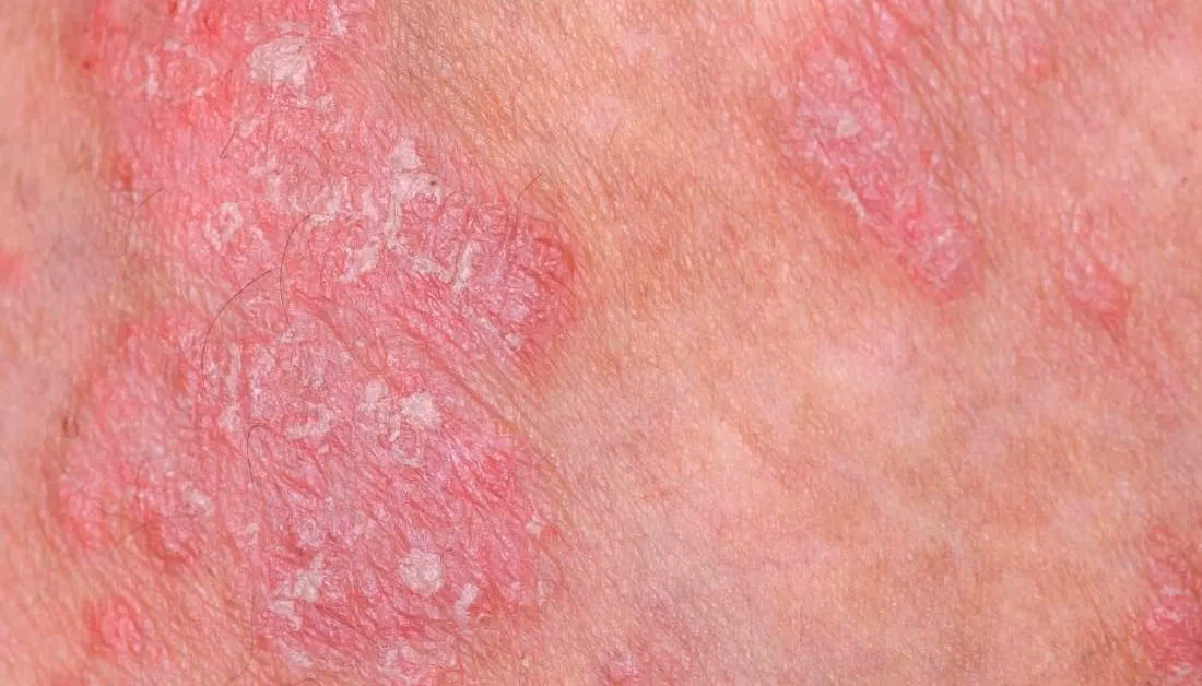 Does vitamin C help psoriasis?