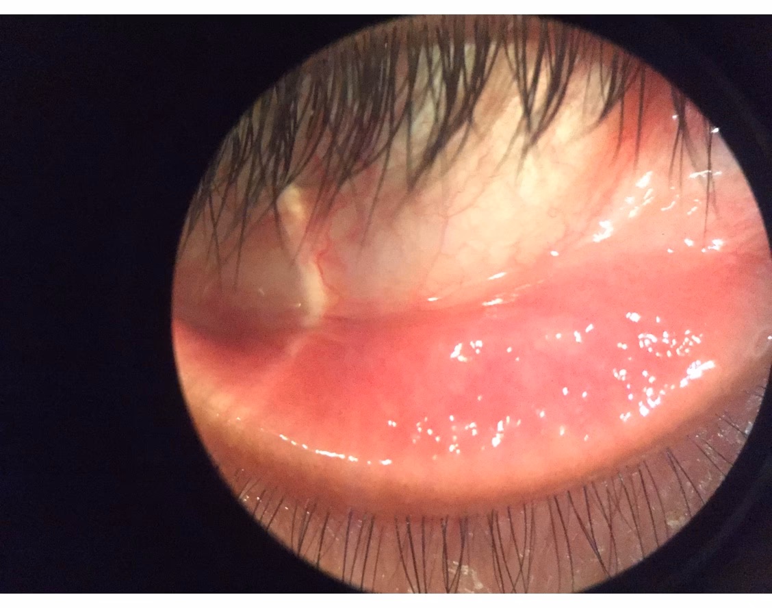 What happens if you eat vog?