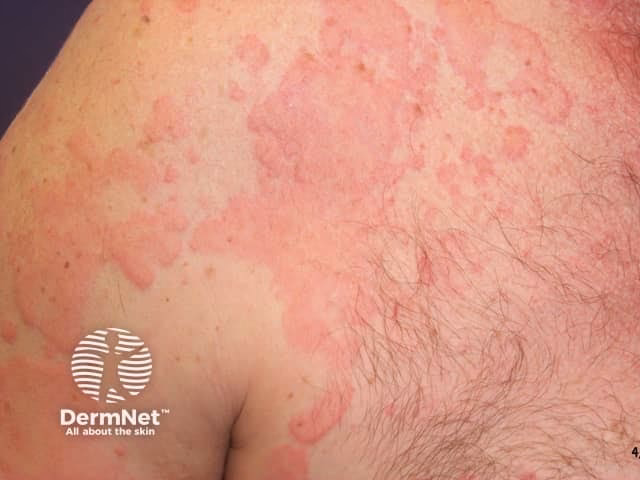 How do I know if I'm allergic to diclofenac?