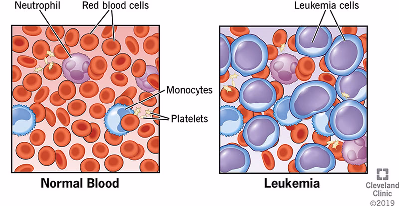 What are Waldenström's macroglobulinemia cancer cells?