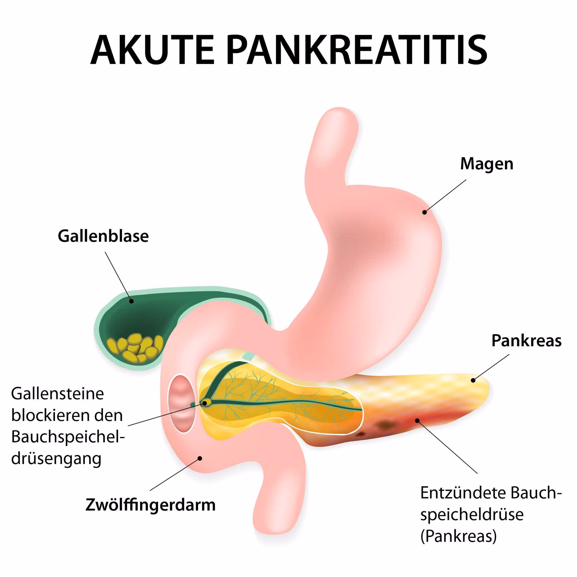 Ist eine akute Pankreatitis heilbar?