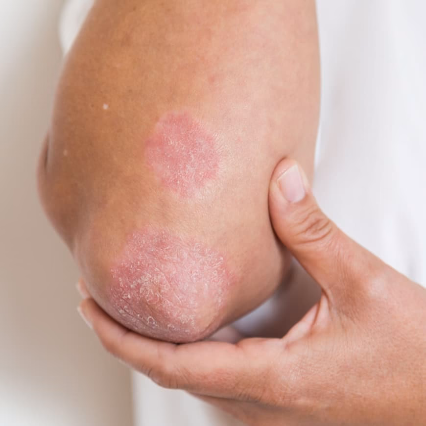 What does Erythrodermic psoriasis look like?