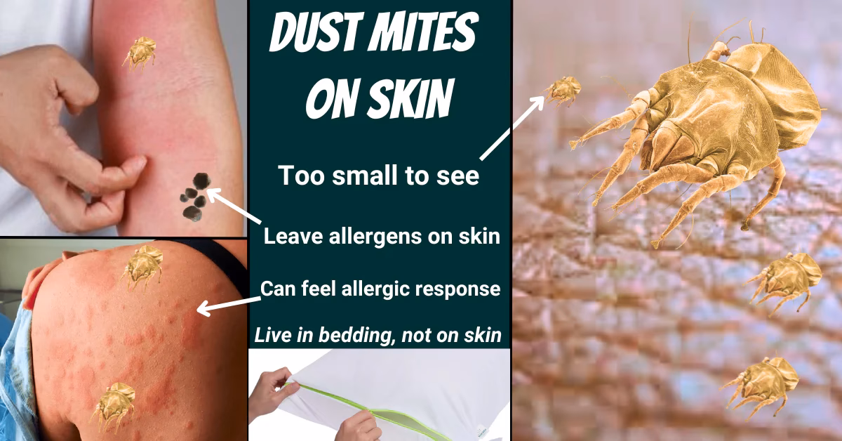 What are dust allergy symptoms?