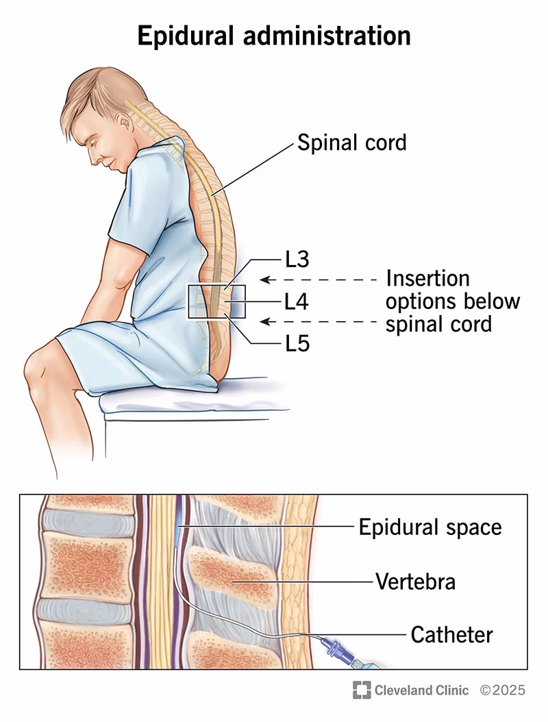 When should you ask for an epidural?