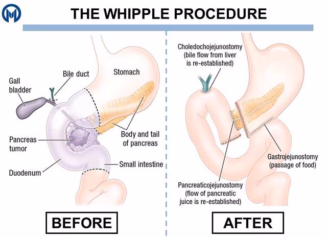 Can Whipple surgery cause partial stomach paralysis?