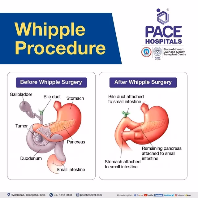 What is the life expectancy after a Whipple surgery?