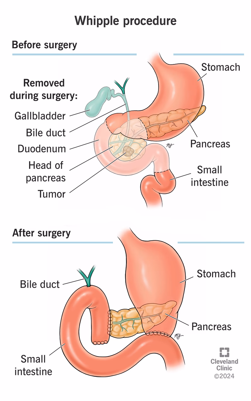How successful is a Whipple surgery?