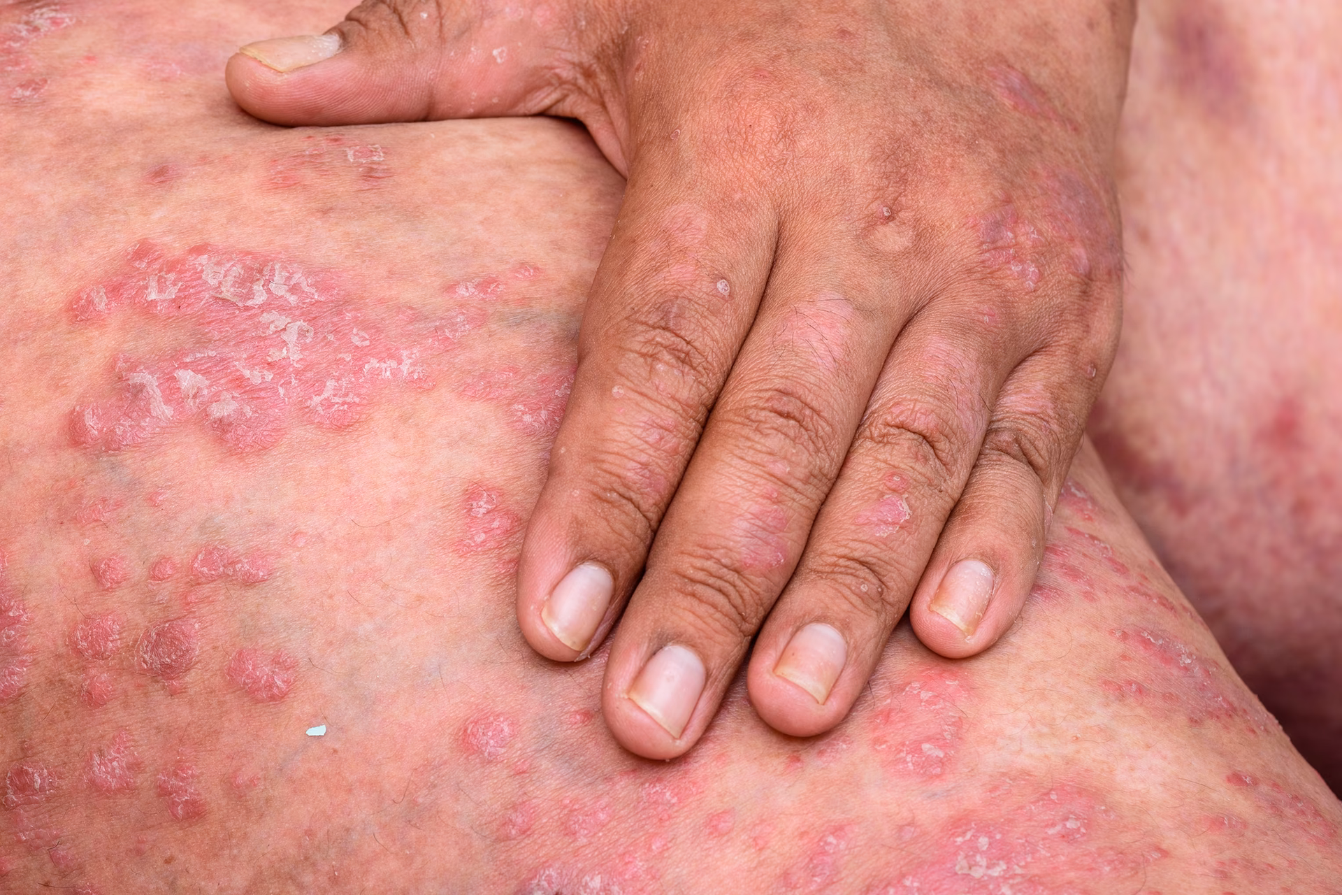 What causes psoriasis symptoms?
