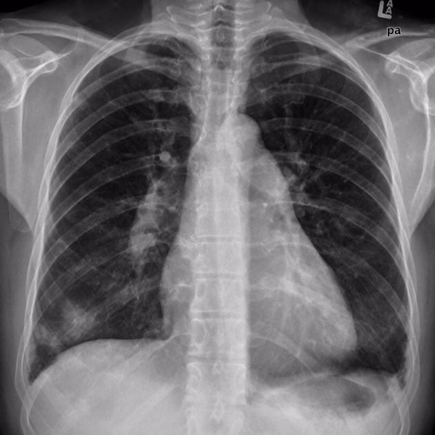 Does a chest X-ray show pulmonary hypertension?