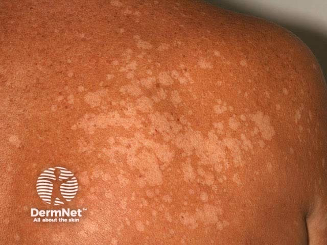 What is tinea pityriasis versicolor?
