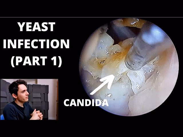 Can a yeast infection cause an outer ear infection?