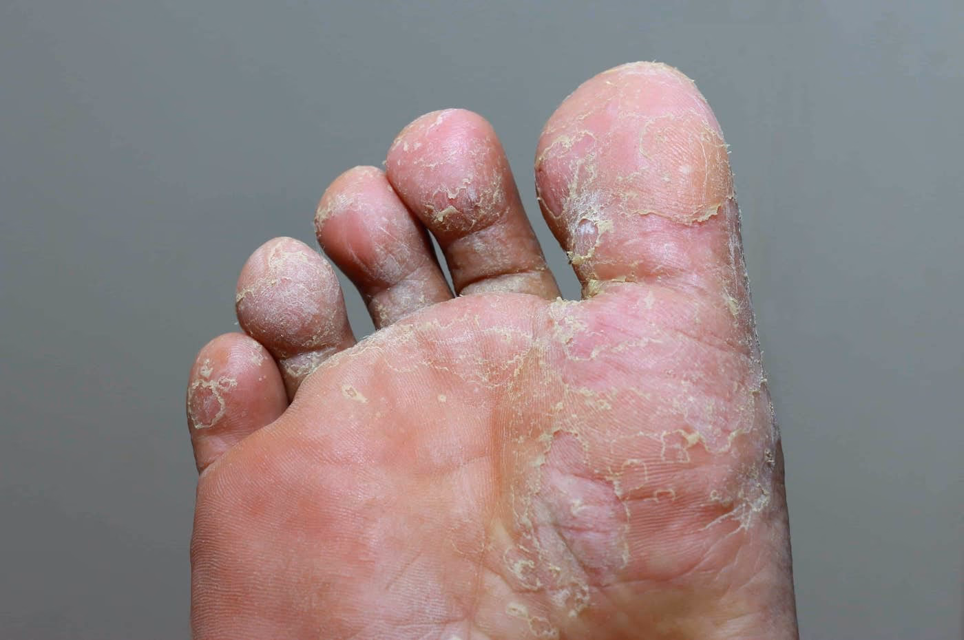 What are the most common foot fungi infections?