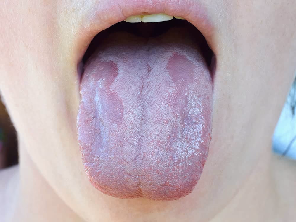 Can you get Candida from kissing?