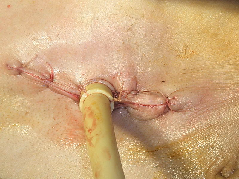 What should I do if I have a yeast infection?