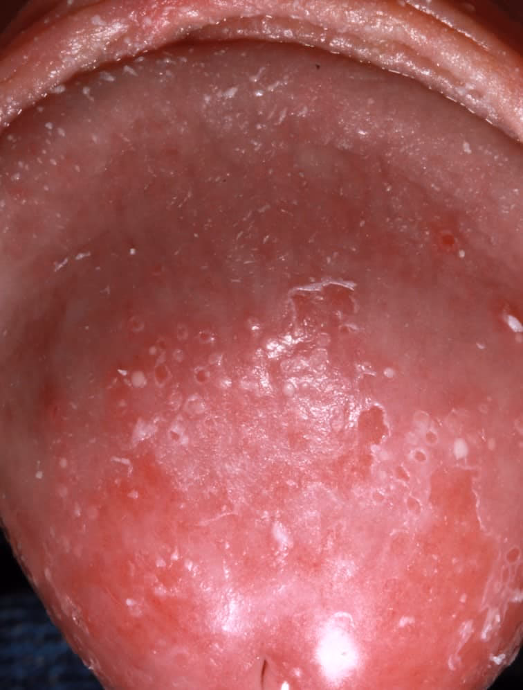 What causes a yeast infection?