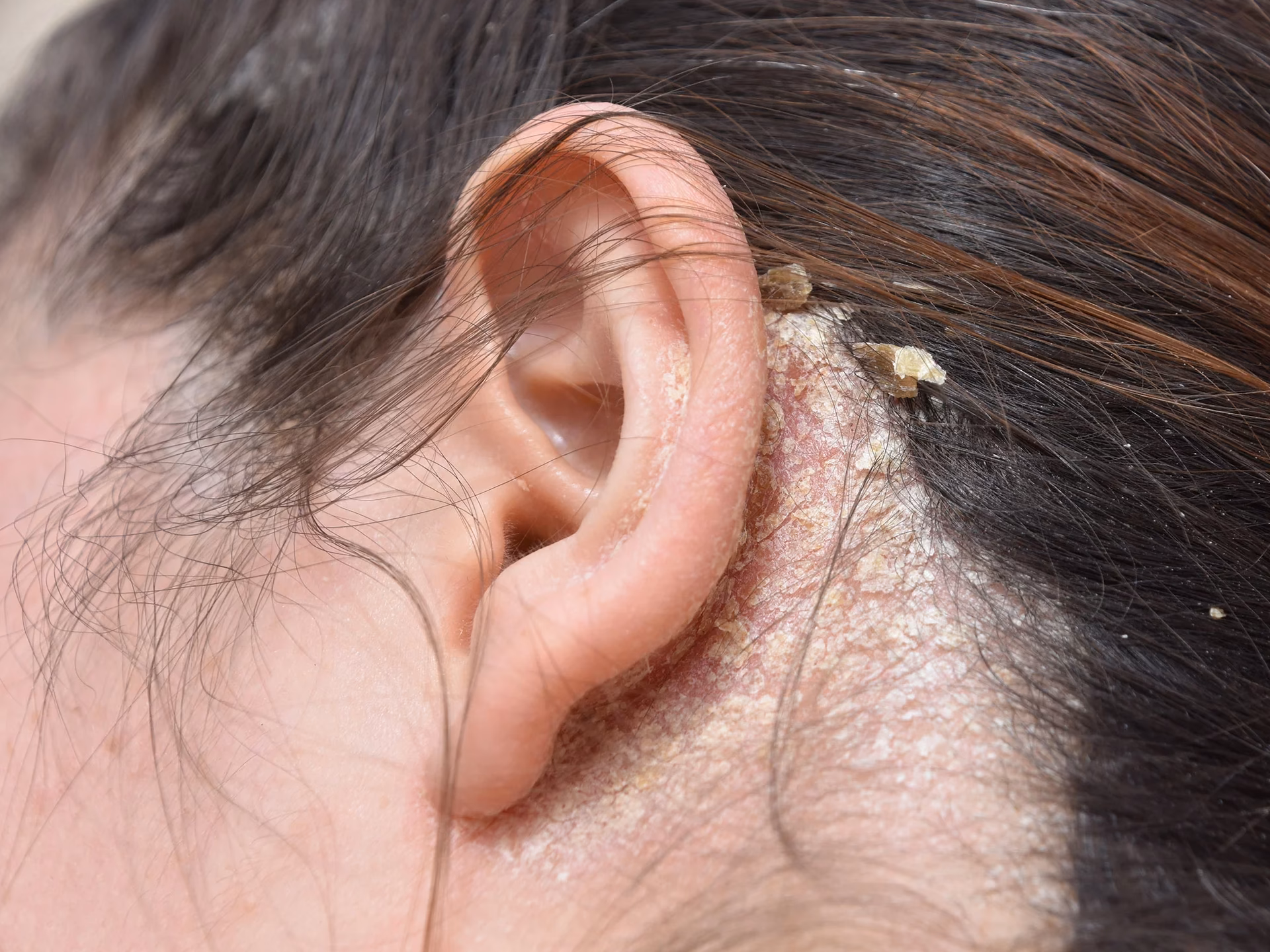 Can you get a yeast infection on your scalp?