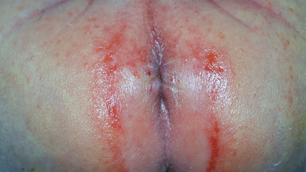 What are the symptoms of a yeast infection?