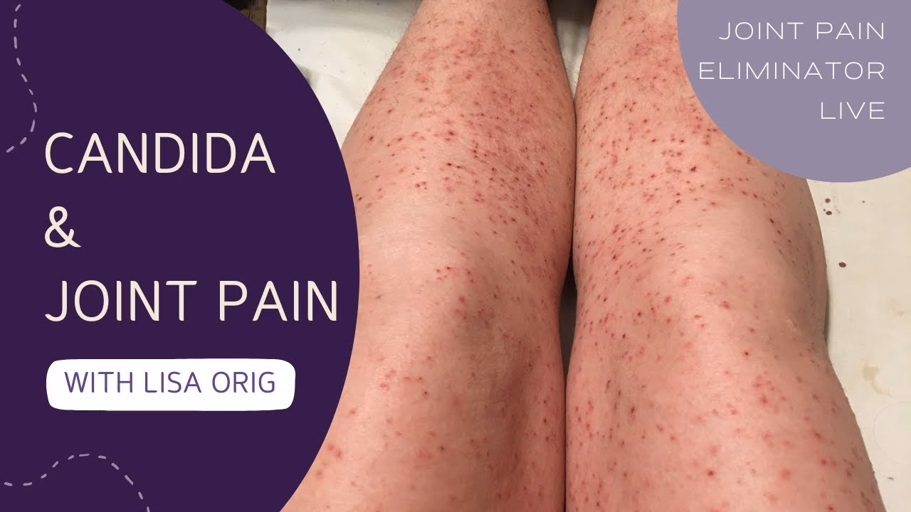Can Candida albicans cause joint pain?