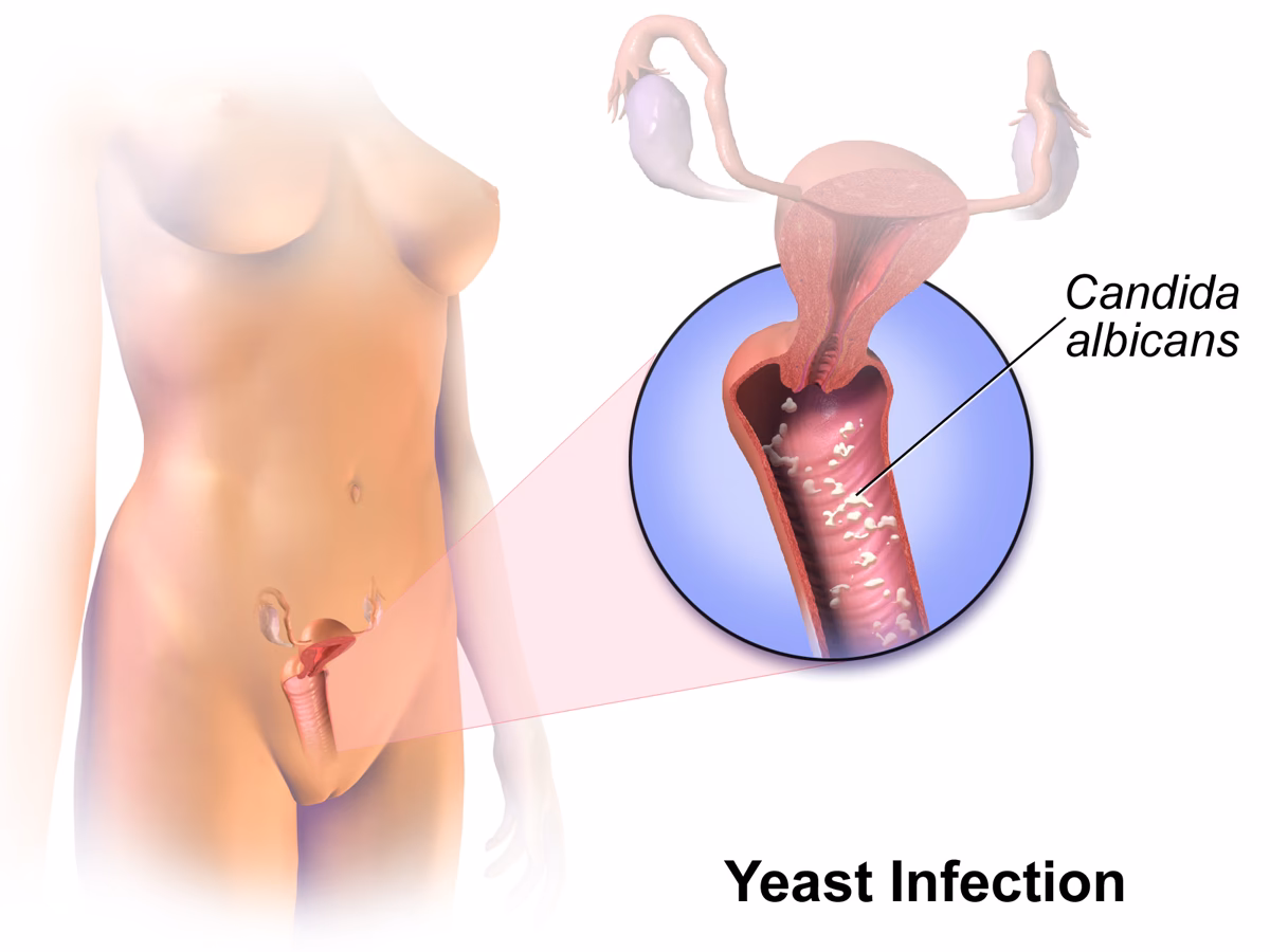 What happens if a yeast infection is left untreated during pregnancy?