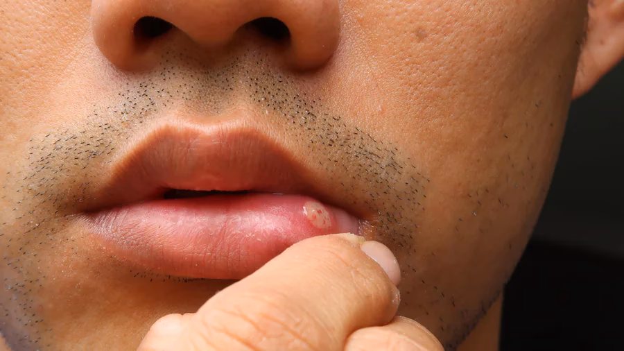 How long does lip fungus treatment last?