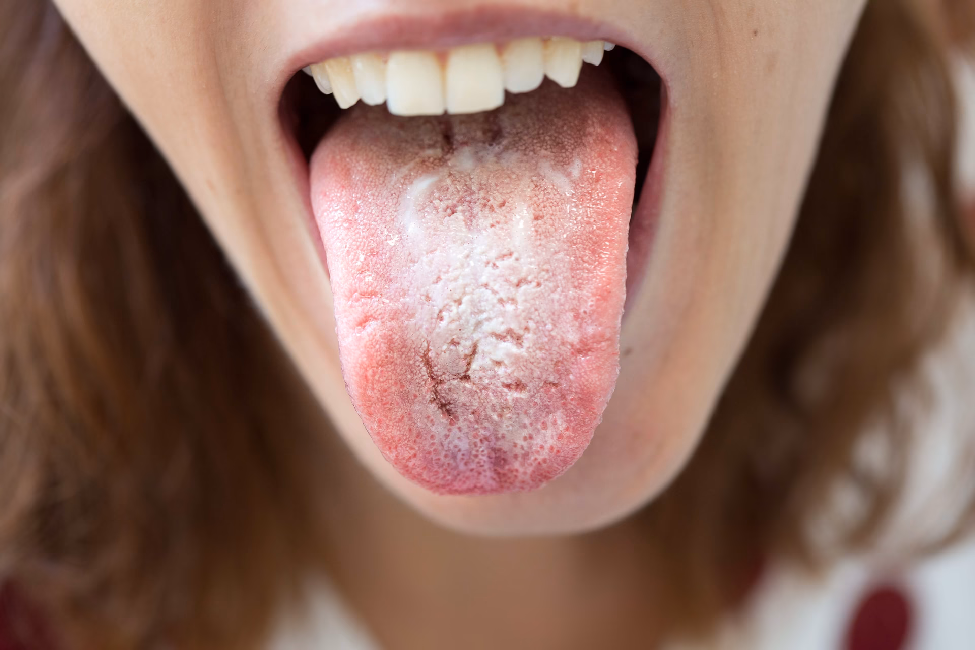 What is a yeast infection in the mouth?