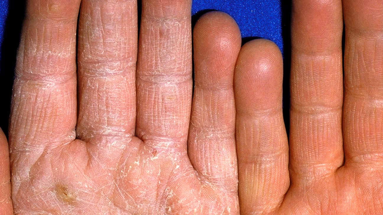 Can a yeast infection on the skin turn into a rash?