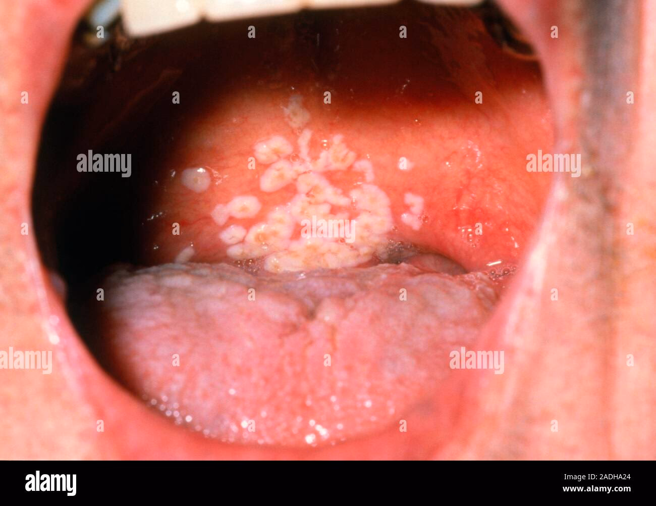 What is vaginal yeast infection?