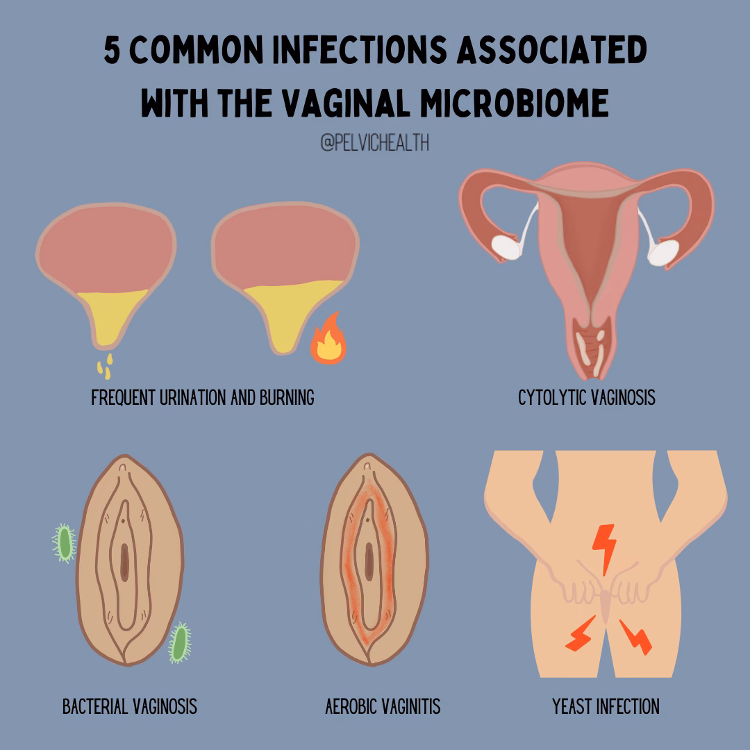 How painful is a yeast infection for a woman?