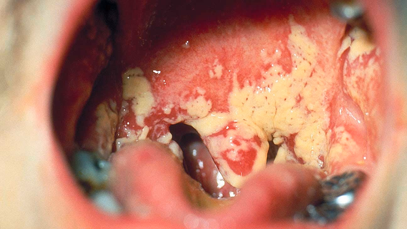 What does thrush in the throat feel like?