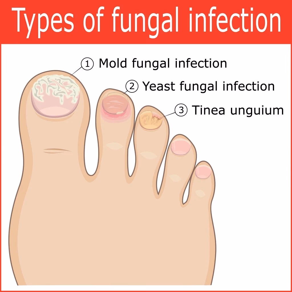 Can a fungal nail infection affect your fingernails?