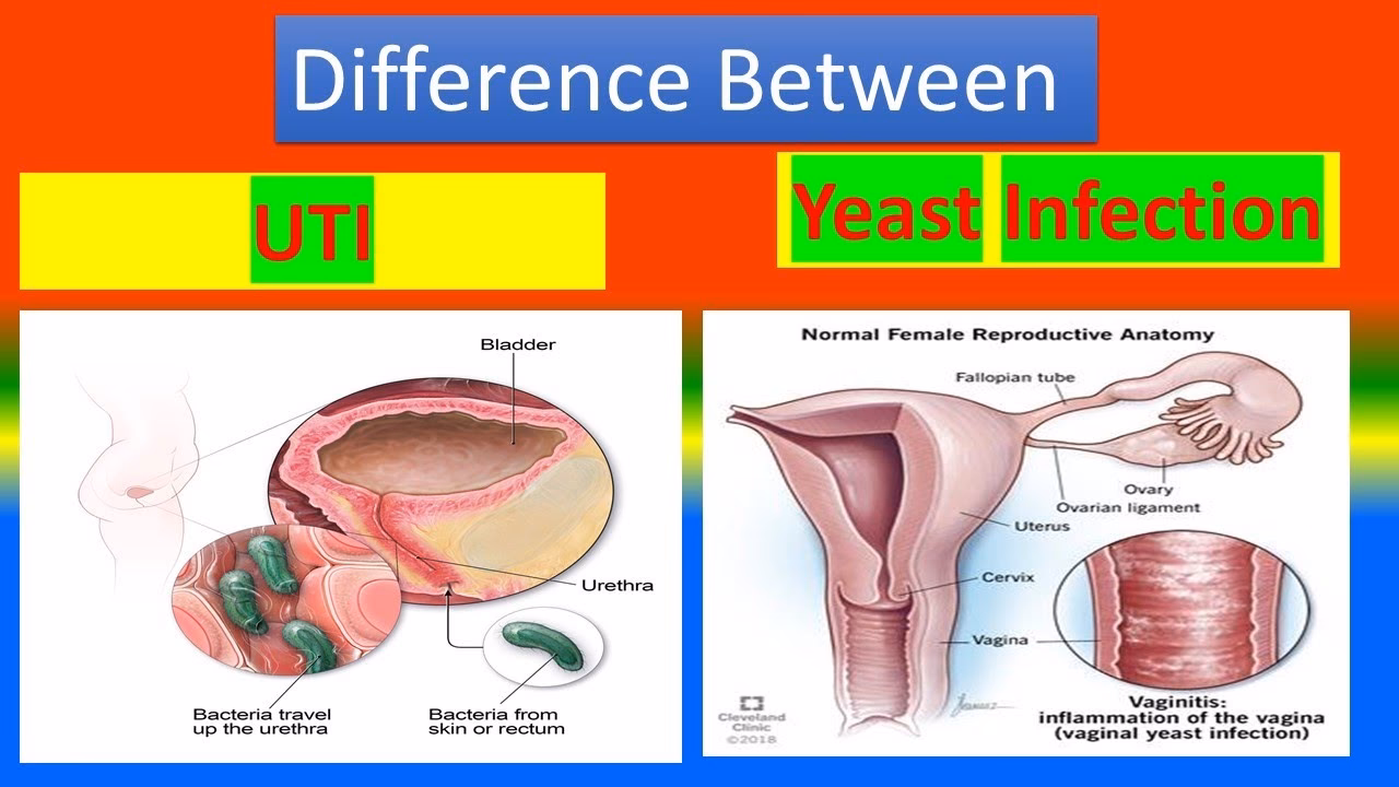 What causes a yeast infection and a UTI?