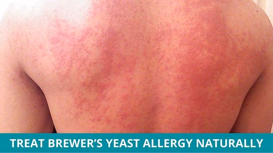 What is a beer allergy?