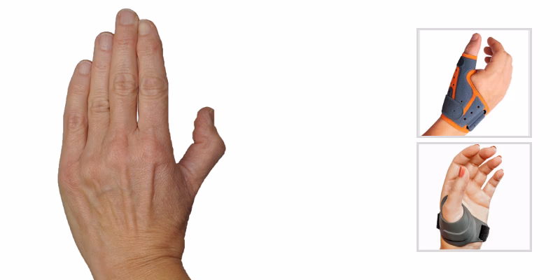 What is zigzag thumb deformity?