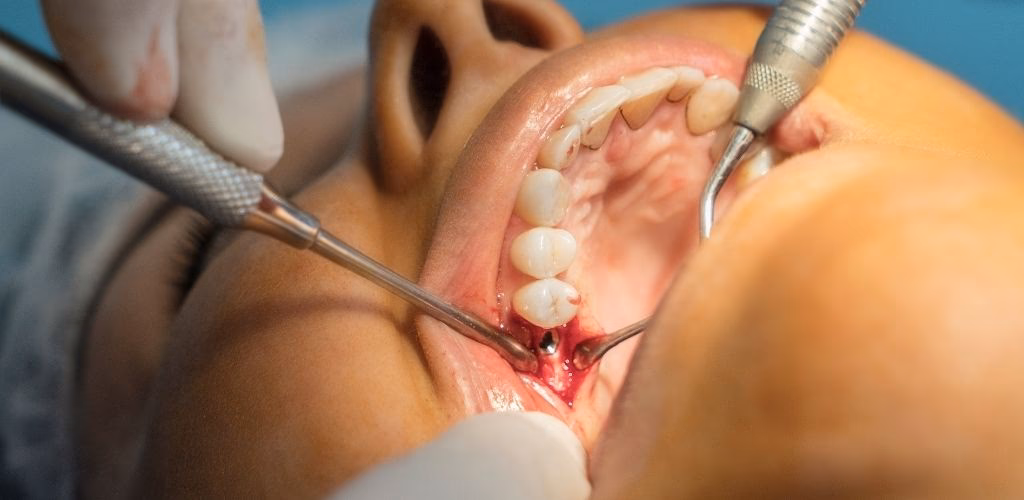 Was ist Eine Zahnimplantation?