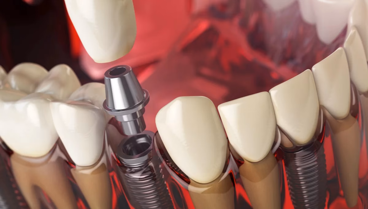 Was ist Eine Zahnimplantation?